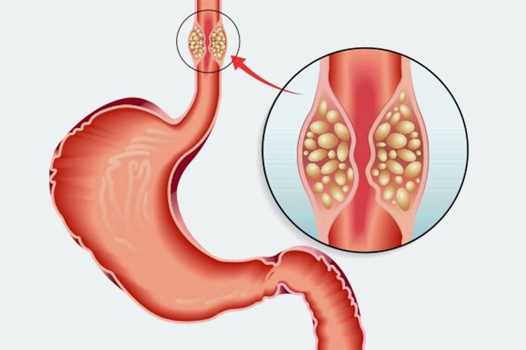 Esophageal Cancer