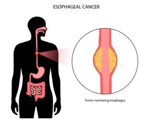Esophageal cancers