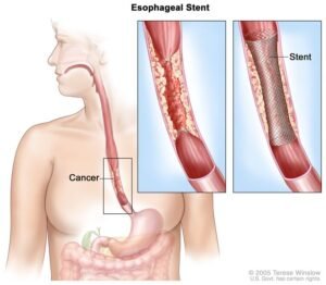 Esophageal Cancer Surgeon in Shalimar Bagh
