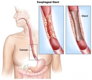 Esophageal Cancer Treatment in New Delhi