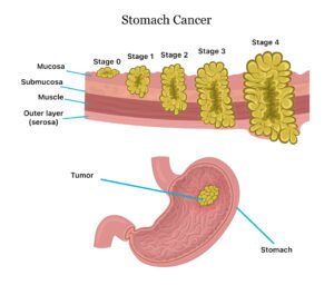 Stomach Cancer Treatment in New Delhi