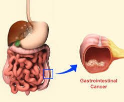 Gastrointestinal Cancer Treatment in New Delhi