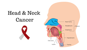 Head and neck cancer Treatment in New Delhi