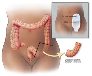 Colon Cancer Treatment in New Delhi