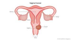 Best Vulvar Cancer Treatment in Shalimar Bagh